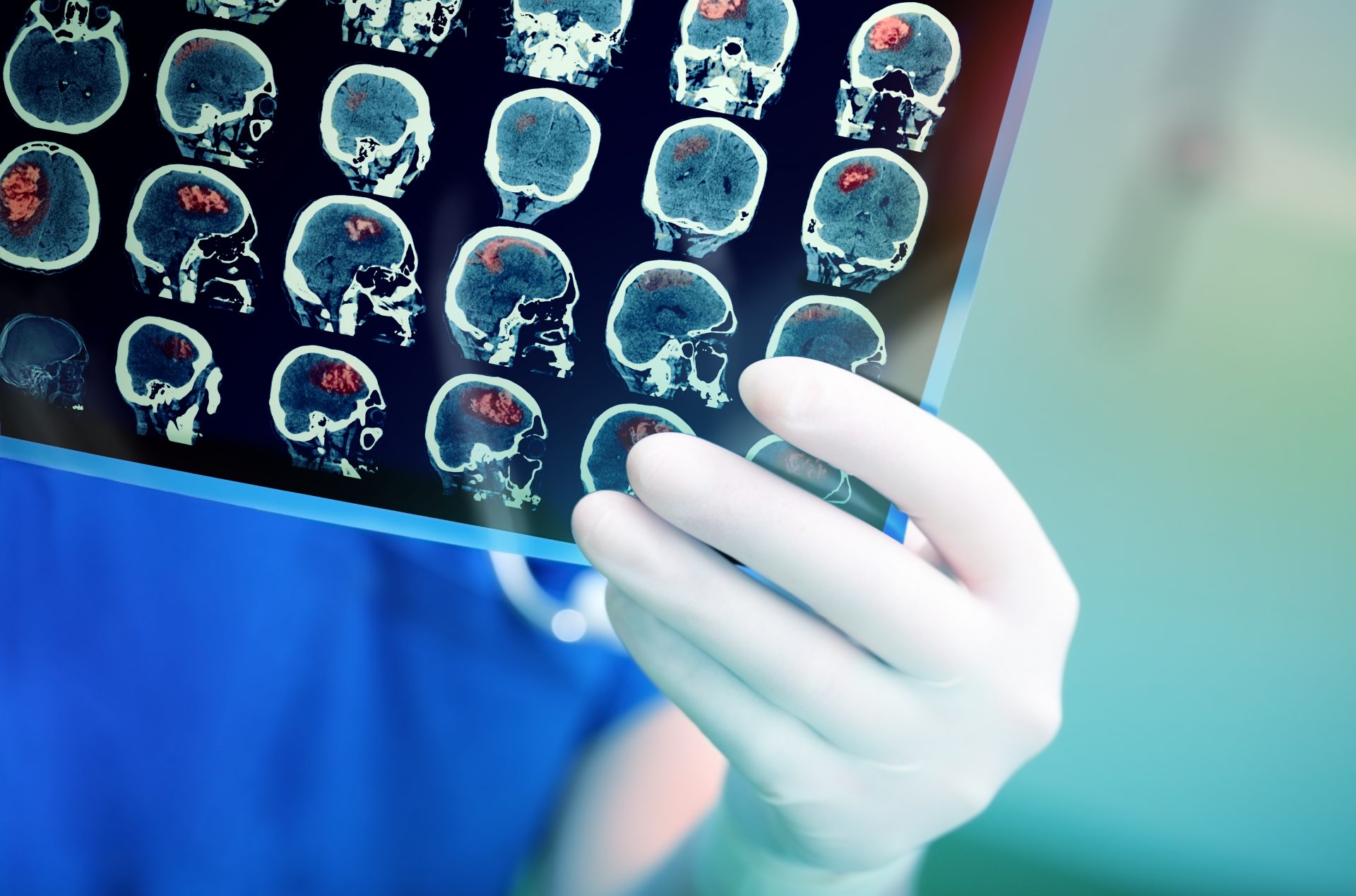 tumori pe creier cauze simptome diagnostic si tratament